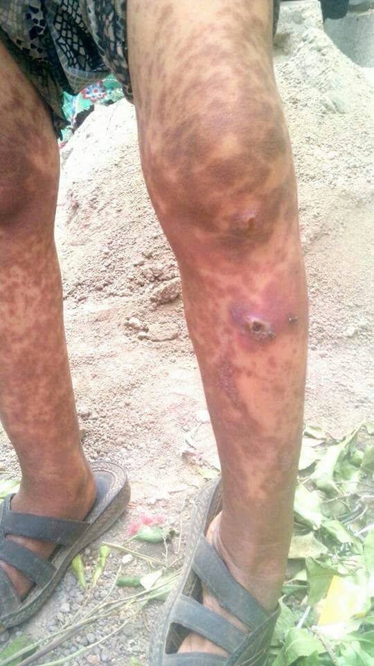 بالصور .. الكيان السعودي يستخدم اسلحة جرثومية في قصف اليمن