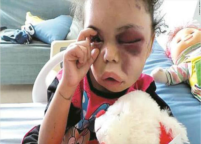 الأمم المتحدة: الأزمة اليمنية الأكبر في العالم