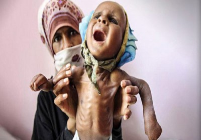 يونيسف: نحو نصف مليون طفل في اليمن في خطر شديد
